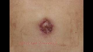 Umbilicoplasty Procedure Thick Scarring [upl. by Nyrad771]