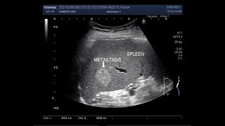 Umbilical Hernia and Splenic lesionMetastasis [upl. by Bevis]