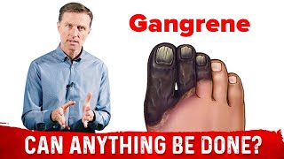 Diabetic Gangrene Symptoms Causes amp Treatment – DrBerg On Diabetic Foot [upl. by Amisoc]