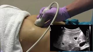 How I do it Ultrasound of the Abdomen [upl. by Lehmann111]