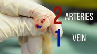 Umbilical Vein Cannulation [upl. by Mary]