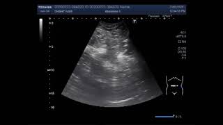 Ultrasound Video showing an Umbilical hernia [upl. by Aynatahs]